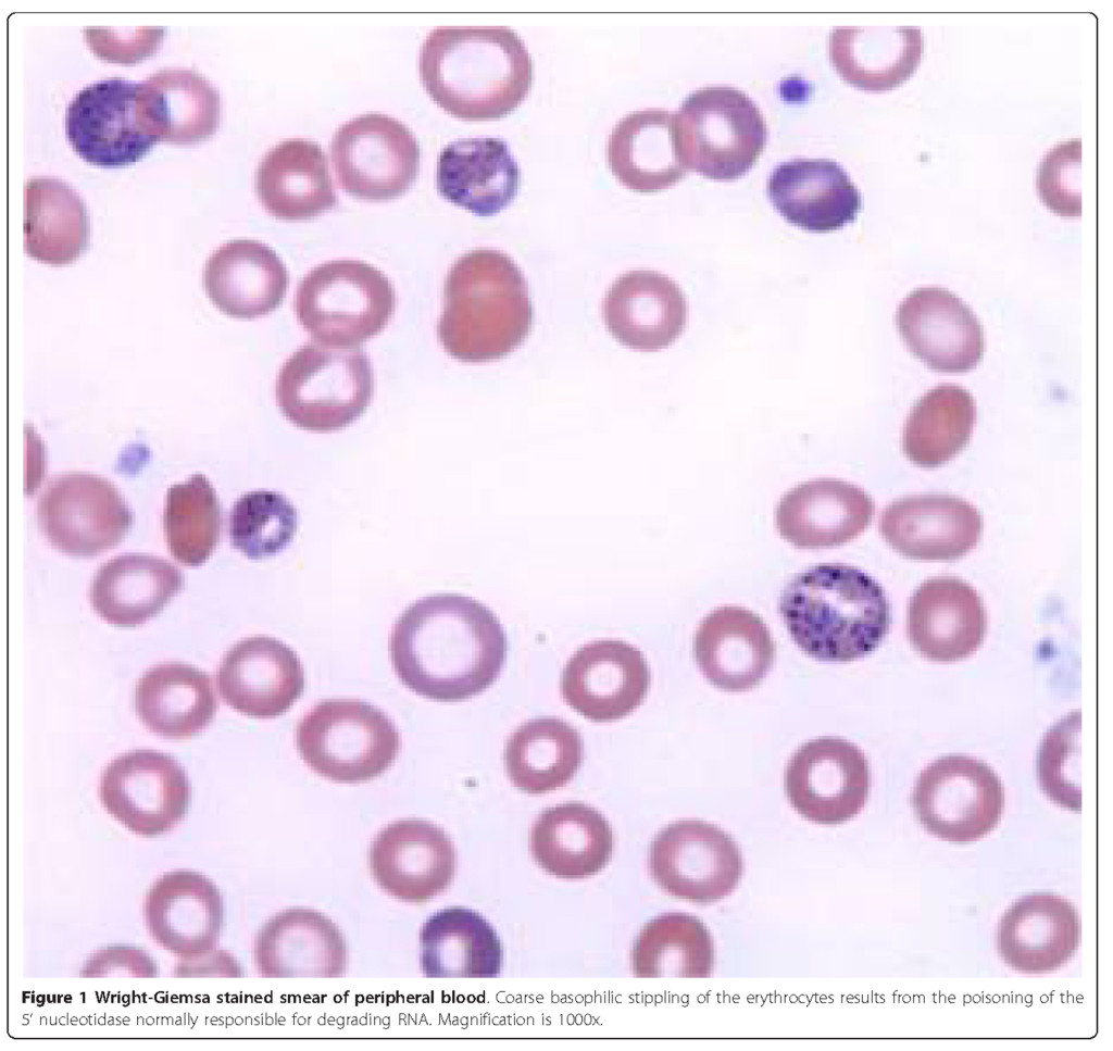Wright-Giemsa stained smear of peripheral blood